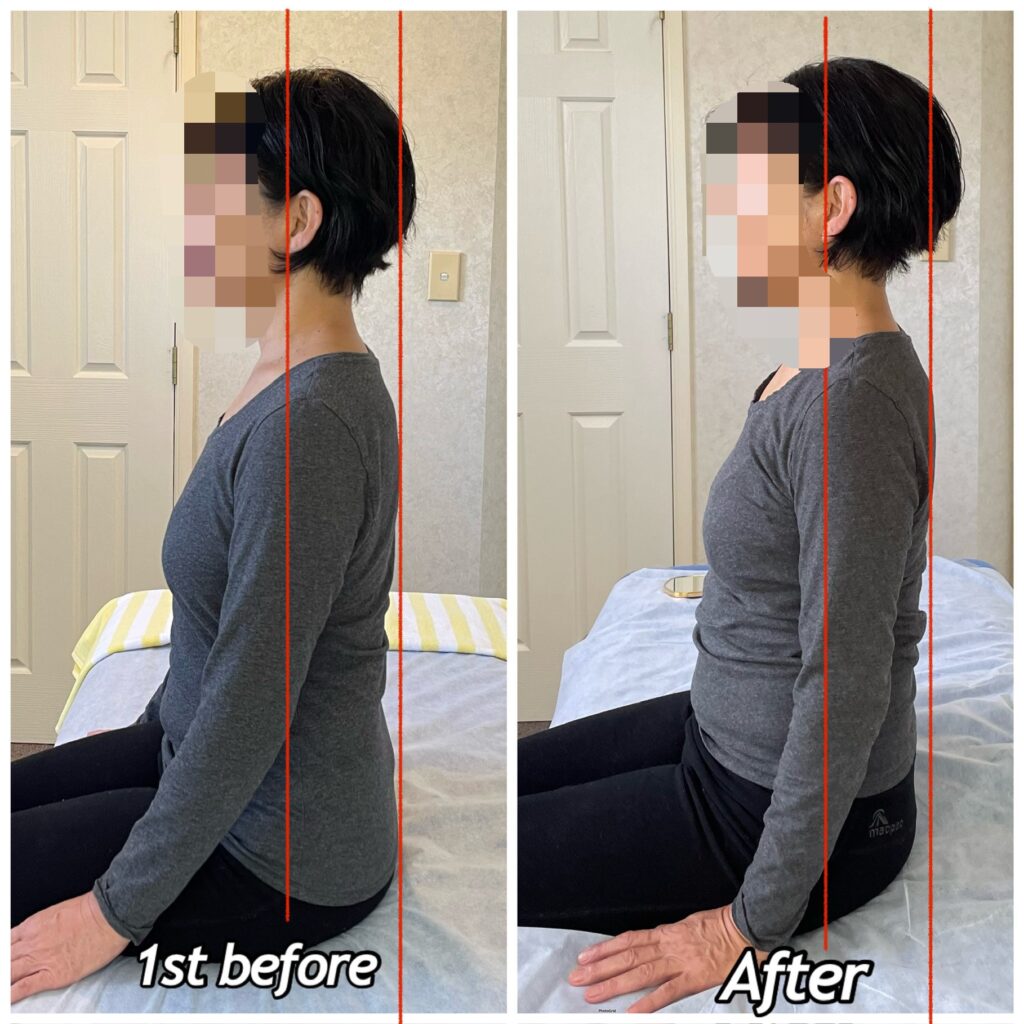 Posture before and after photos